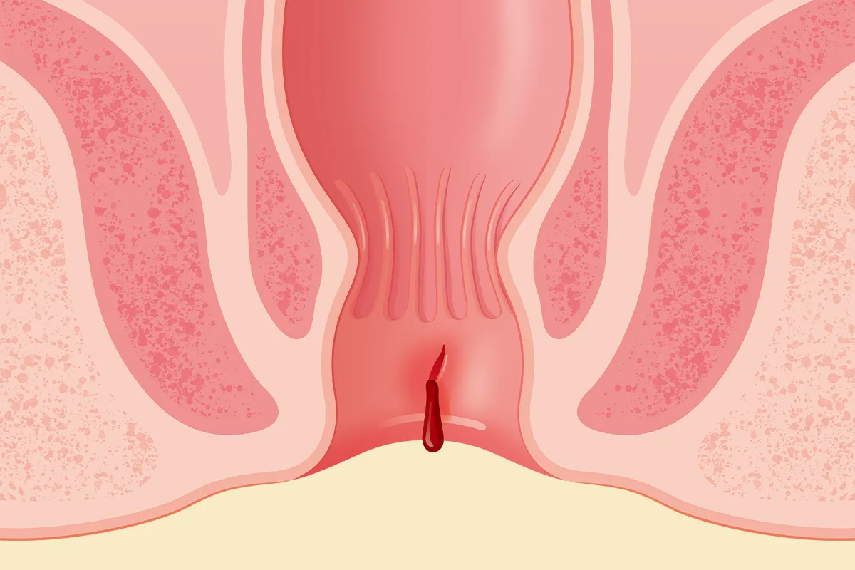 Schemendarstellung After mit Analfissur