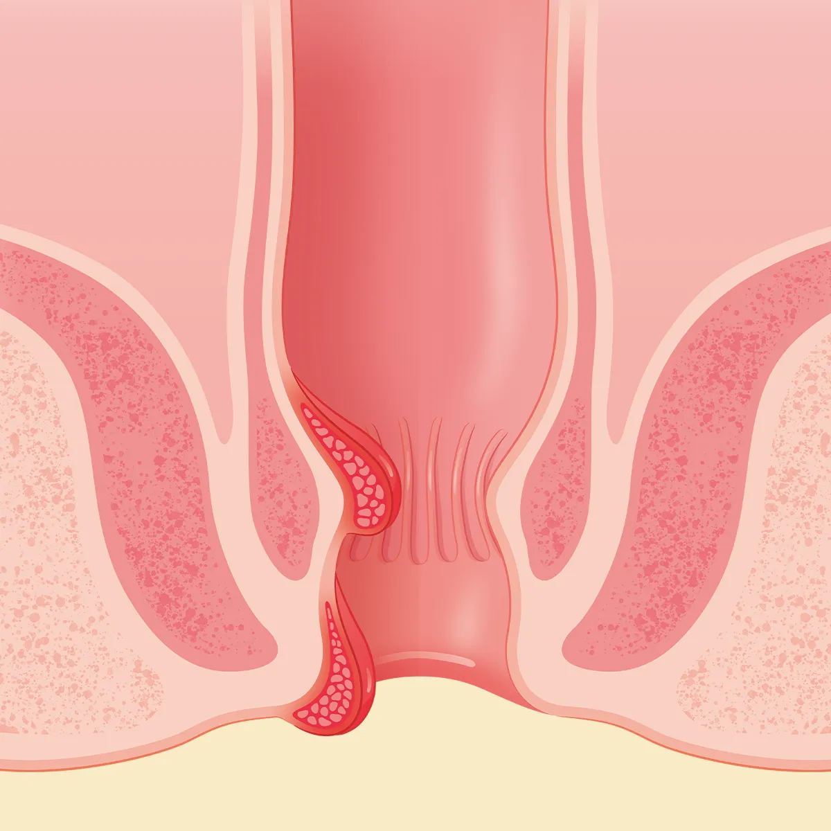 Schemendarstellung After mit Hämorrhoiden